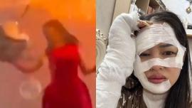 ΒΙΝΤΕΟ-Γενέθλια φρίκης για 33χρονη – Έσκασε στο πρόσωπό της μπαλόνι με υδρογόνο που ακούμπησε στα κεριά της τούρτας της