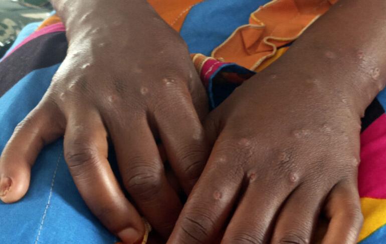 ΠΟΥ: Η ευλογιά των πιθήκων δεν αποτελεί πλέον έκτακτη ανάγκη