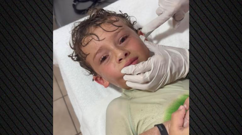Καβούρι μπήκε στο αυτί παιδιού στο Μεξικό, βίντεο από τη στιγμή που οι γιατροί το βγάζουν ζωντανό