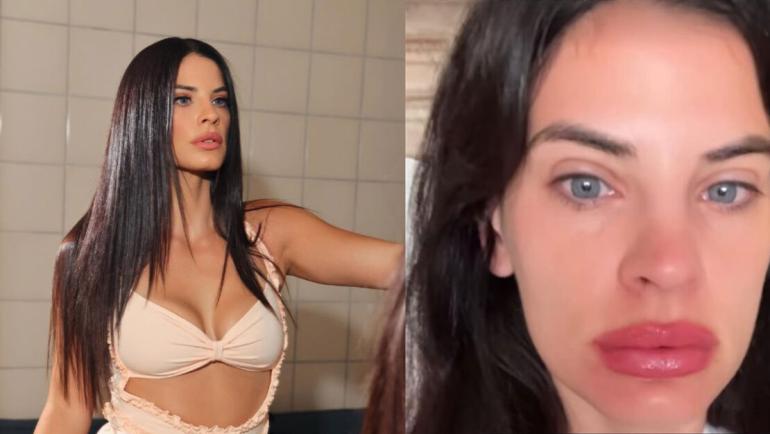 Χριστίνα Μπόμπα: «Ξύπνησα έτσι, τα χείλη μου έγιναν τριπλάσια»